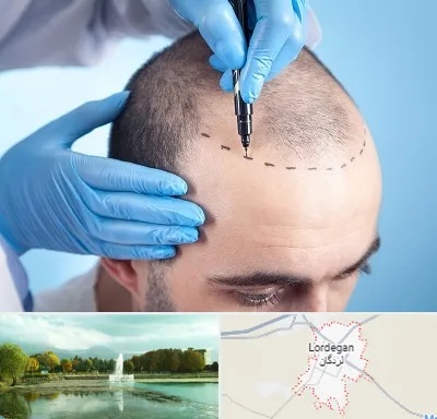 دکتر کاشت مو در لردگان