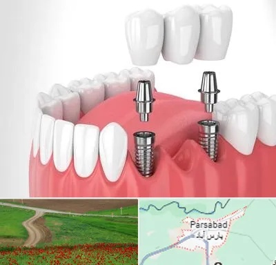 کاشت دندان در پارس آباد