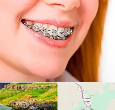 ارتودنسی ارزان در عجب شیر