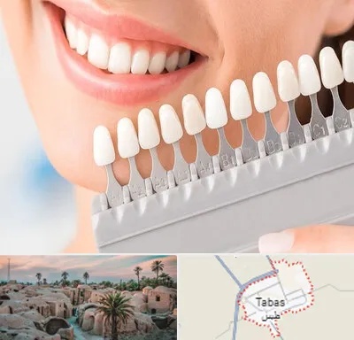 متخصص لمینت دندان در طبس