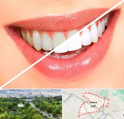 بلیچینگ دندان در البرز