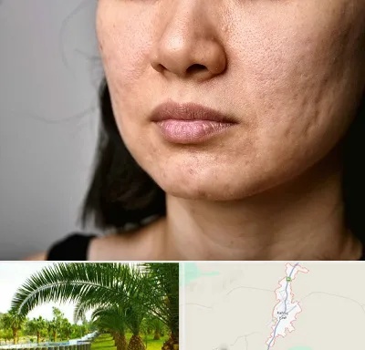 سابسیژن جای جوش در کهنوج