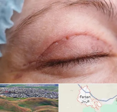 جراح پلک در فارسان