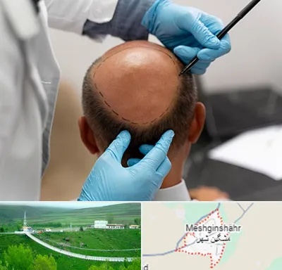 آموزش کاشت مو در مشگین شهر