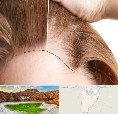 کاشت مو برای خانمها در گرمسار