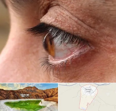 متخصص قوز قرنیه در گرمسار