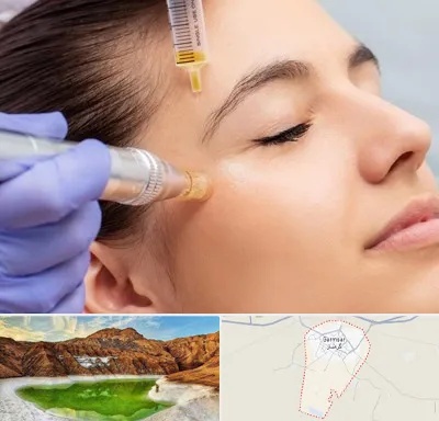 میکرونیدلینگ در گرمسار