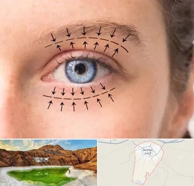 عمل افتادگی پلک در گرمسار