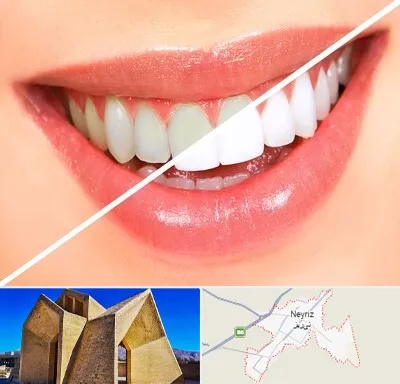 بلیچینگ دندان در نی ریز