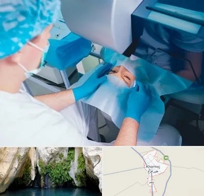 دکتر عمل لازک چشم در خورموج