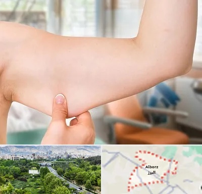 براکیوپلاستی در البرز