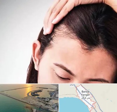 کاشت مو بانوان در بندر کنگان