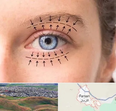 عمل افتادگی پلک در فارسان
