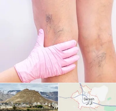دکتر فوق تخصص واریس در گراش