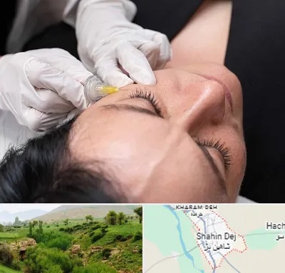 کربوکسی تراپی در شاهین دژ