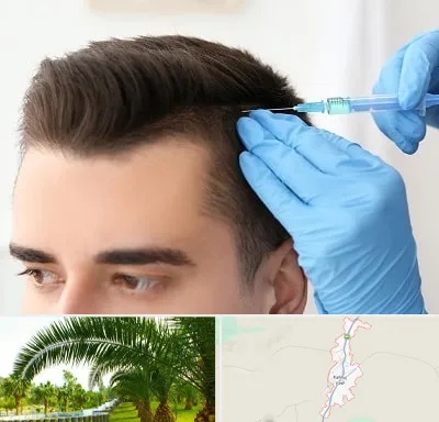 مزوتراپی مو در کهنوج