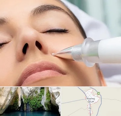 پلاسما جت بینی در خورموج