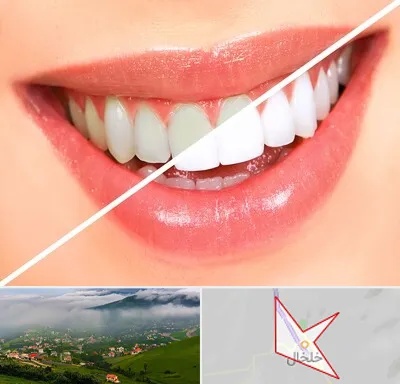 بلیچینگ دندان در خلخال