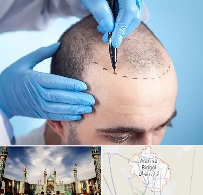 دکتر کاشت مو در آران و بیدگل