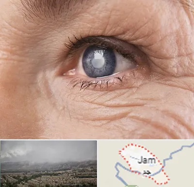 متخصص آب مروارید در جم