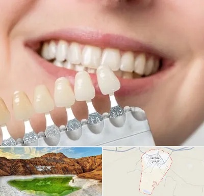 مرکز کامپوزیت دندان در گرمسار