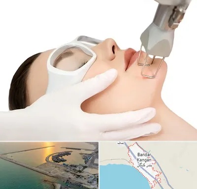 لیزر فرکشنال در بندر کنگان