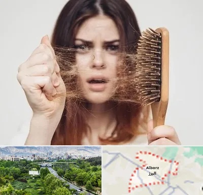 دکتر ریزش مو در البرز