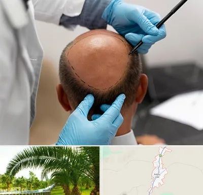 آموزش کاشت مو در کهنوج