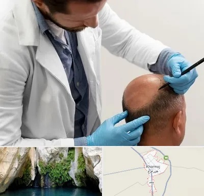 کاشت مو به روش تکثیری در خورموج