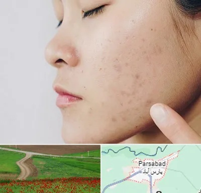 دکتر جوش صورت در پارس آباد