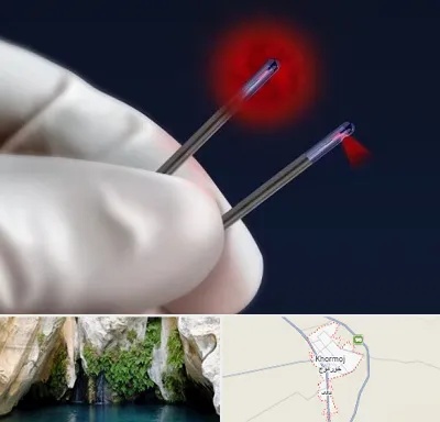 جراحی سینه با لیزر در خورموج