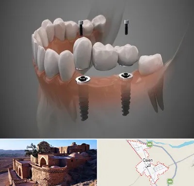 ایمپلنت دیجیتال در قائن