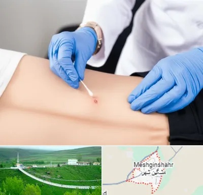 متخصص زخم بستر در مشگین شهر