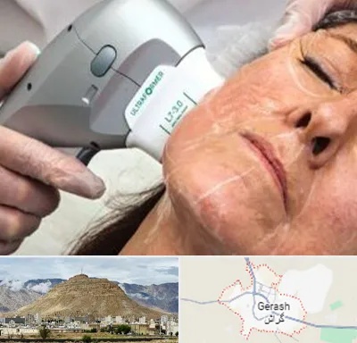 آموزش هایفوتراپی در گراش