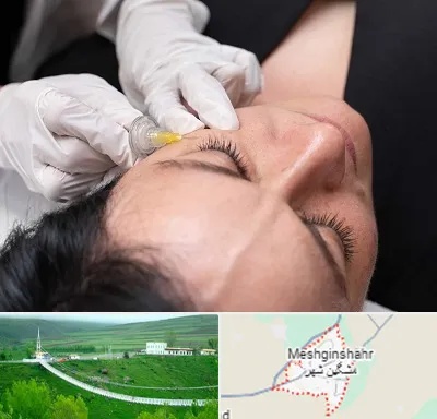 کربوکسی تراپی در مشگین شهر