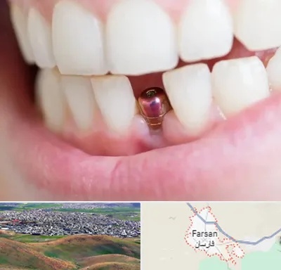 ایمپلنت اقساطی در فارسان