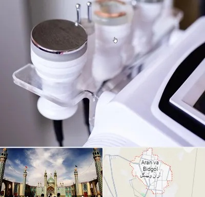 مرکز لاغری با کویتیشن در آران و بیدگل