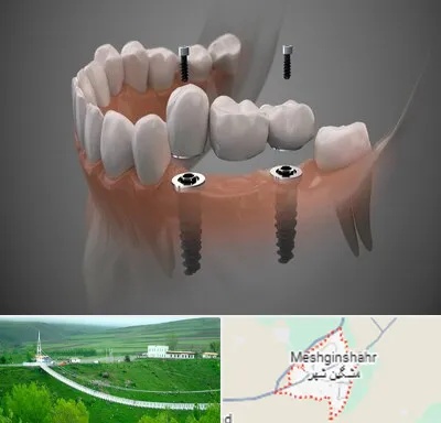 ایمپلنت دیجیتال در مشگین شهر