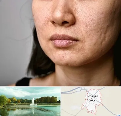 سابسیژن جای جوش در لردگان