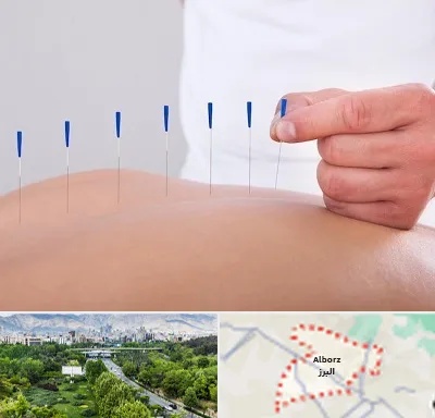 دکتر طب سوزنی در البرز