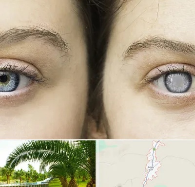 متخصص آب سیاه (گلوکوم) در کهنوج