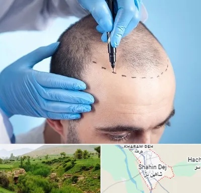 دکتر کاشت مو در شاهین دژ