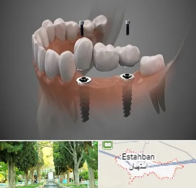 ایمپلنت دیجیتال در استهبان
