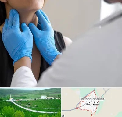 دکتر سرطان گلو در مشگین شهر