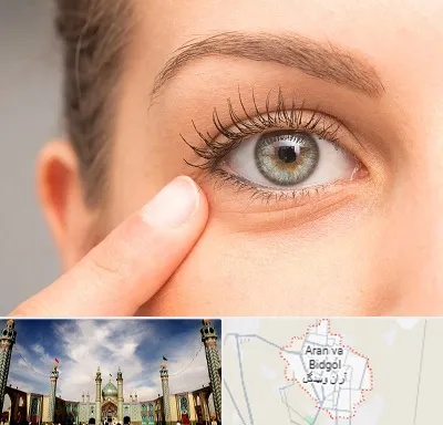 جراح پف چشم در آران و بیدگل