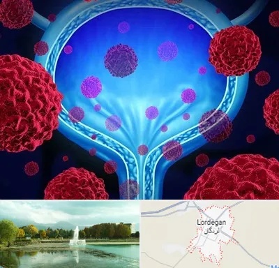 دکتر سرطان مثانه در لردگان