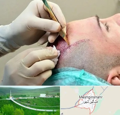 کلینیک کاشت مو در مشگین شهر