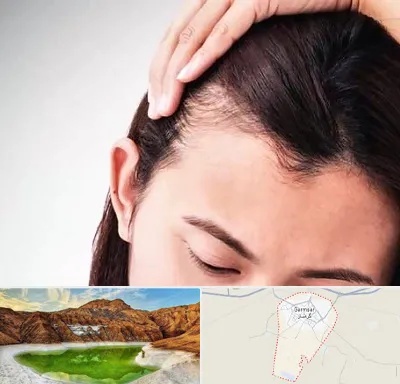 کاشت مو بانوان در گرمسار