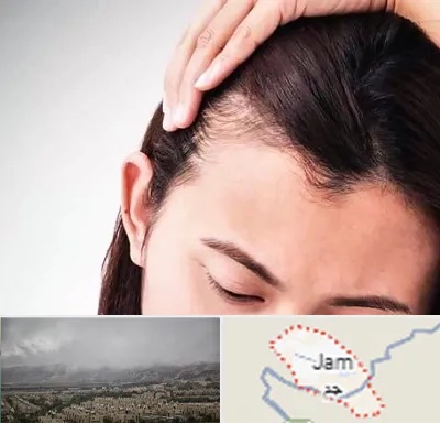 کاشت مو بانوان در جم