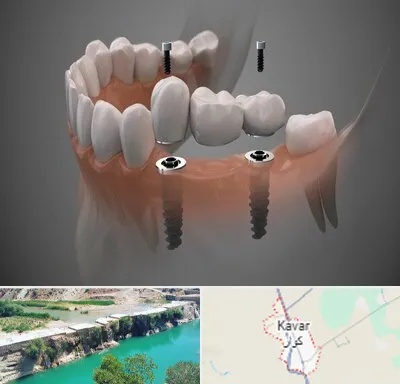 ایمپلنت دیجیتال در کوار